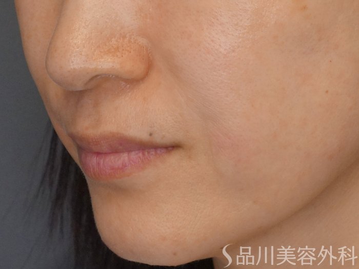 症例NO.71860のAFTER写真