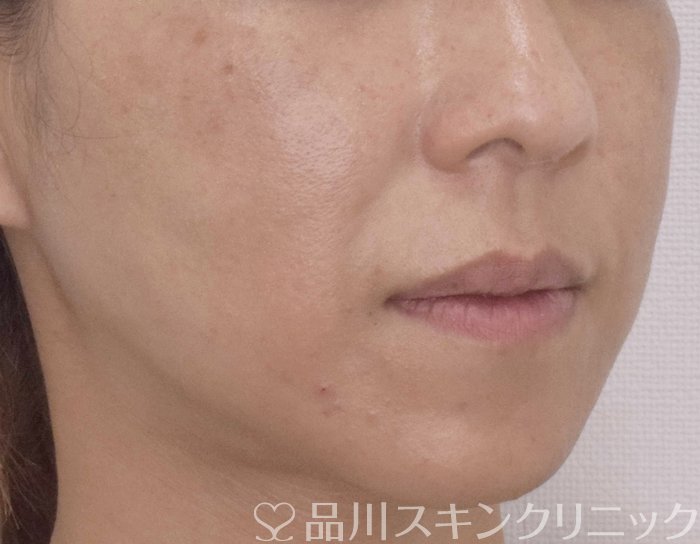 症例NO.72314のAFTER写真