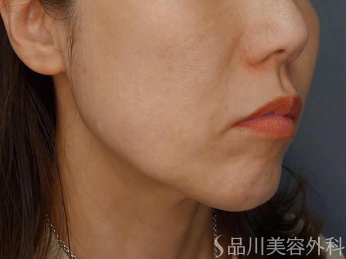 症例NO.69967のBEFORE写真