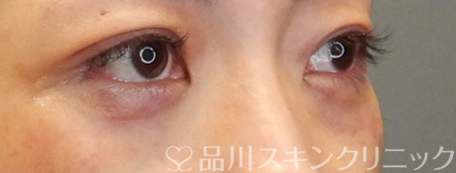 症例NO.66353のAFTER写真