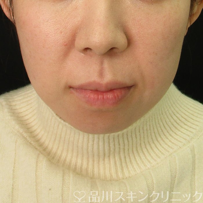 症例NO.72656のBEFORE写真