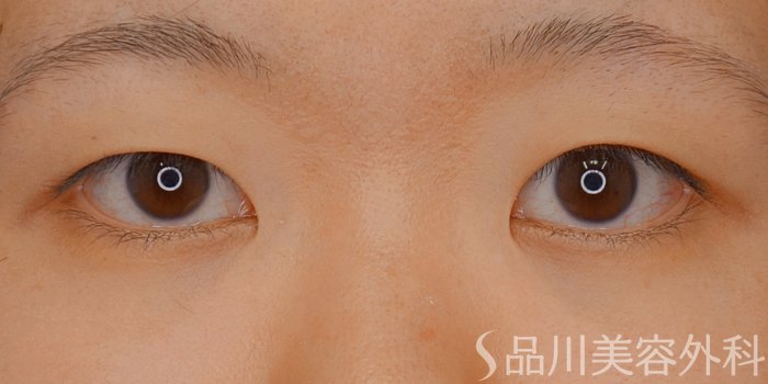 症例NO.71658のBEFORE写真