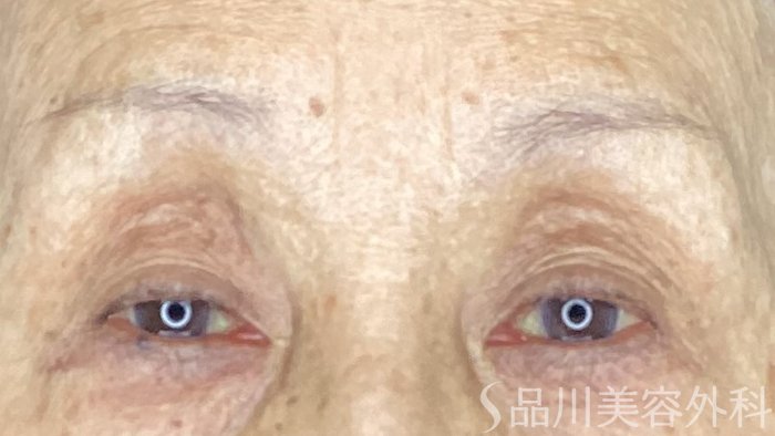 症例NO.69511のBEFORE写真