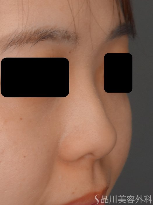 症例NO.73467のBEFORE写真