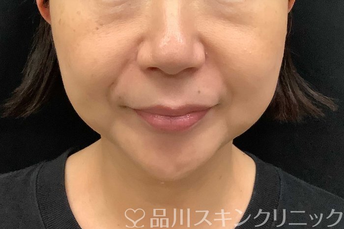 症例NO.69779のBEFORE写真