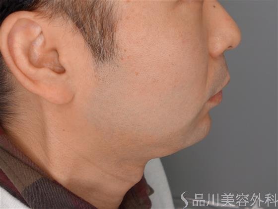 症例NO.53677のAFTER写真