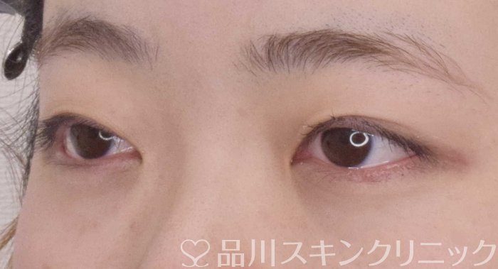 症例NO.68024のBEFORE写真