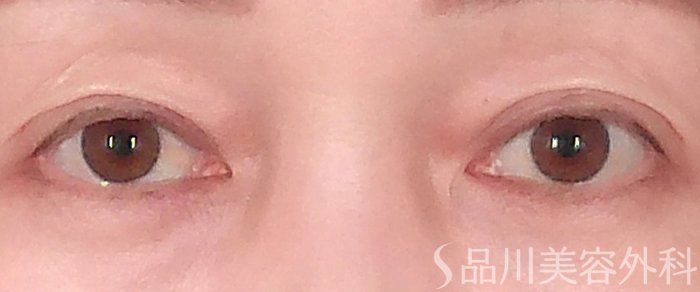 症例NO.69940のAFTER写真