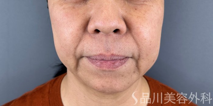 症例NO.64815のBEFORE写真