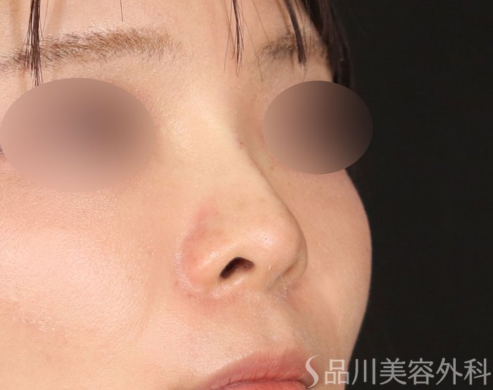 症例NO.72323のAFTER写真