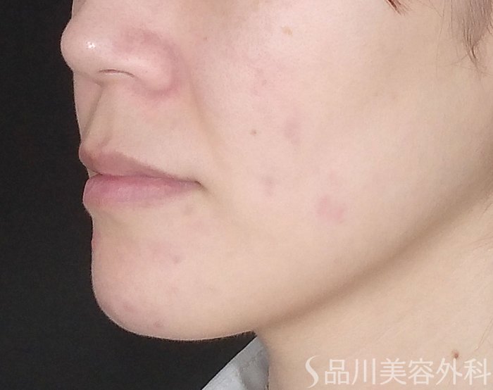 症例NO.65124のBEFORE写真