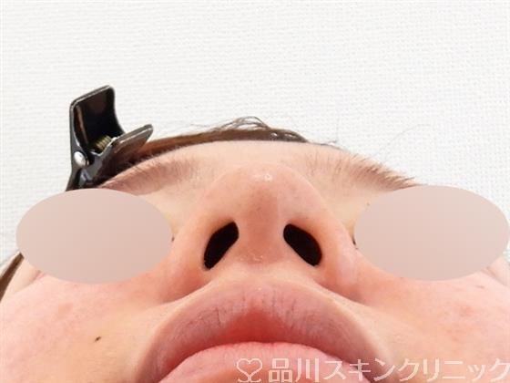 症例NO.61961のBEFORE写真