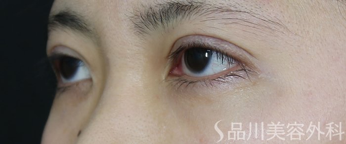 症例NO.72087のAFTER写真