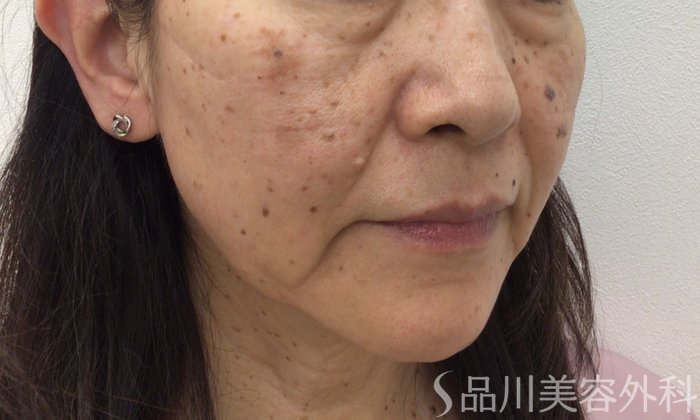 症例NO.62153のBEFORE写真