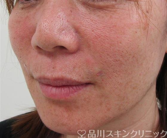 症例NO.30748のAFTER写真