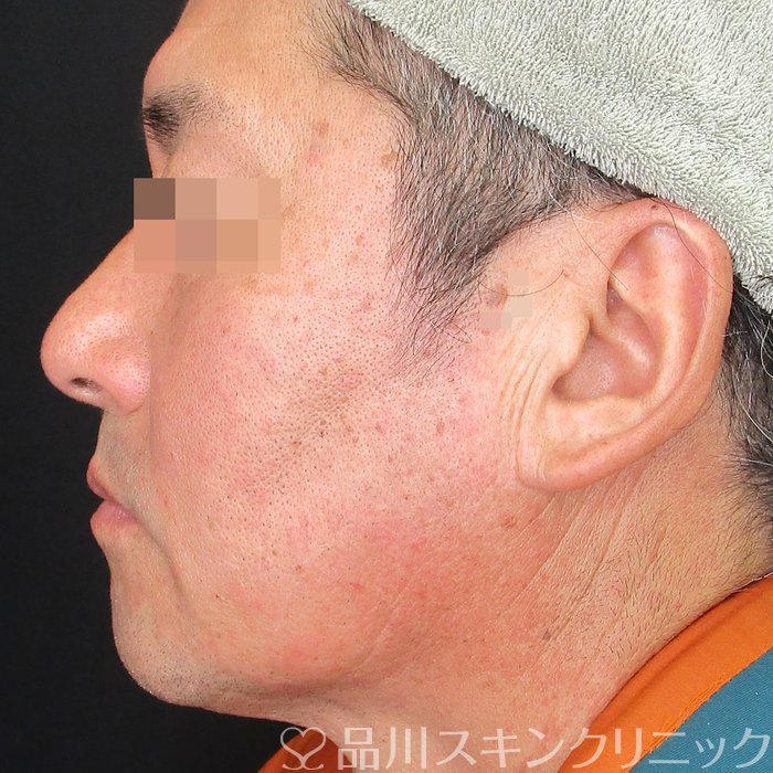 症例NO.73638のBEFORE写真