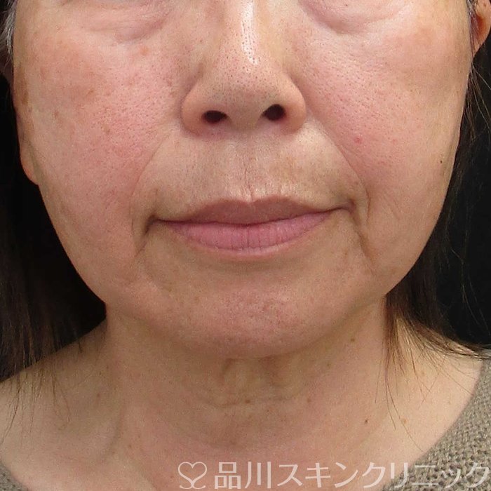 症例NO.64739のBEFORE写真