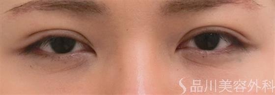 症例NO.25130のAFTER写真