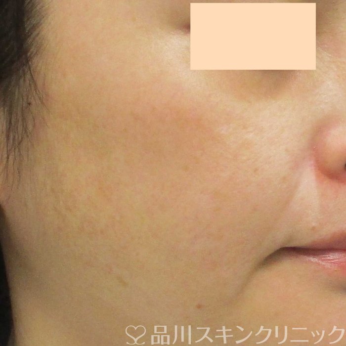 症例NO.69341のAFTER写真