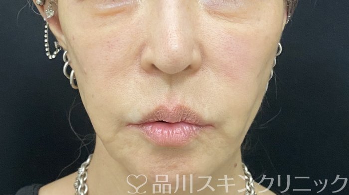 症例NO.74504のAFTER写真