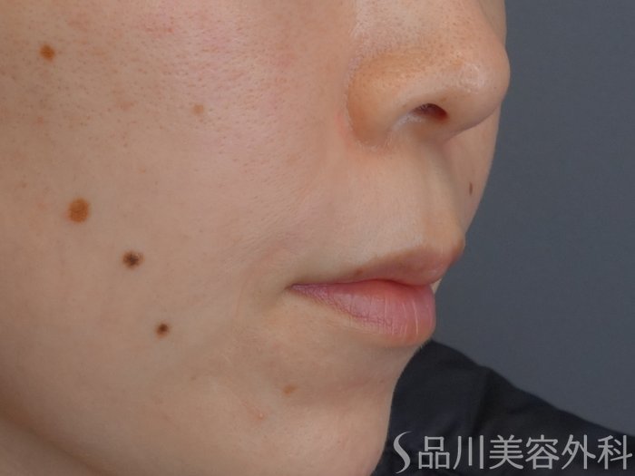 症例NO.72592のAFTER写真