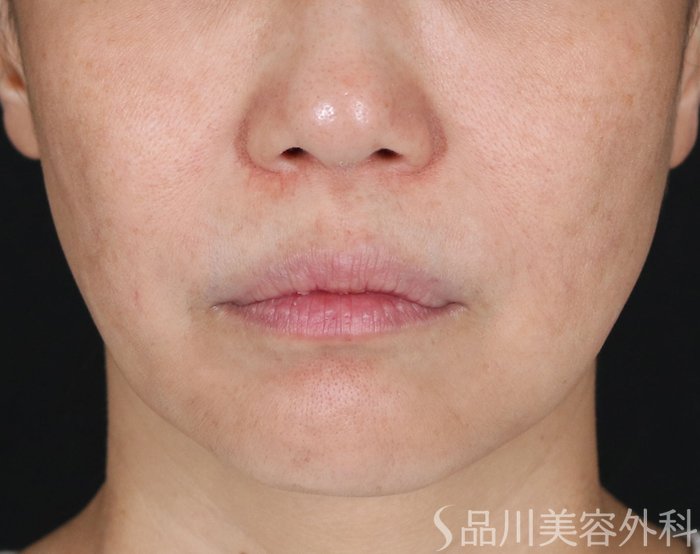 症例NO.71373のBEFORE写真