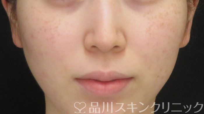 症例NO.70820のBEFORE写真