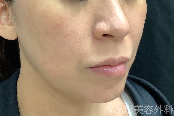 症例NO.67798のAFTER写真