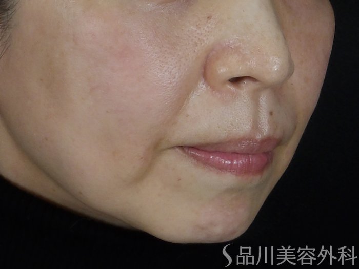 症例NO.69833のBEFORE写真