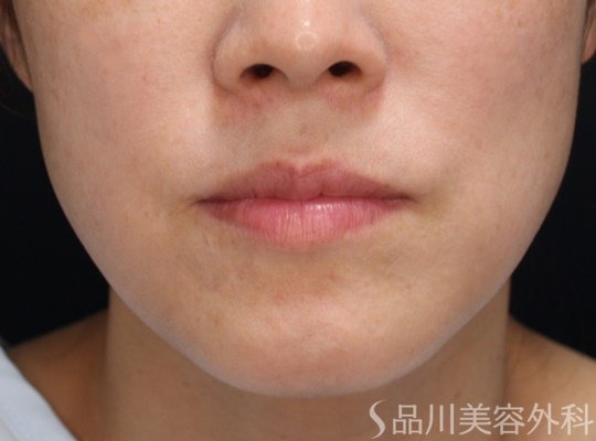 症例NO.69603のBEFORE写真