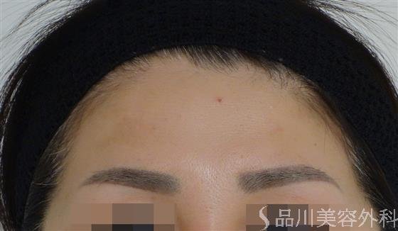 症例NO.49464のBEFORE写真