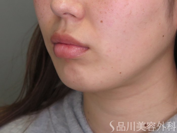 症例NO.71380のBEFORE写真
