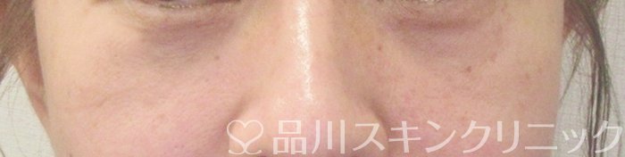 症例NO.70461のAFTER写真