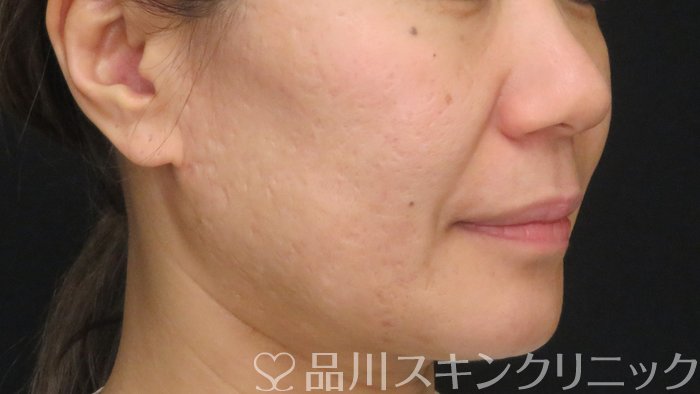 症例NO.71121のBEFORE写真