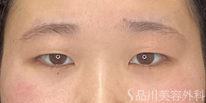 症例NO.73242のBEFORE写真