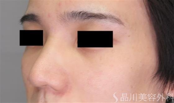 症例NO.48397のBEFORE写真