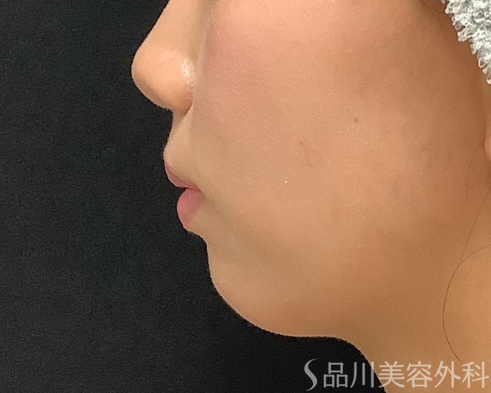 症例NO.75339のBEFORE写真