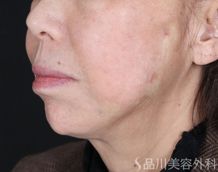 症例NO.72388のAFTER写真