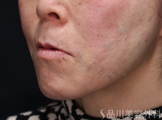 症例NO.73370のAFTER写真