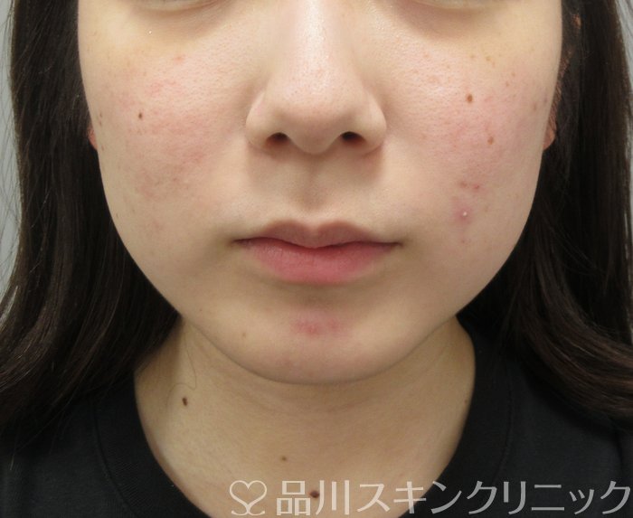 症例NO.73809のBEFORE写真