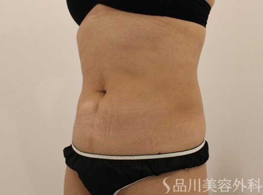 症例NO.71694のAFTER写真