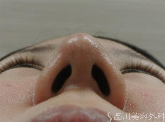 症例NO.16020のAFTER写真
