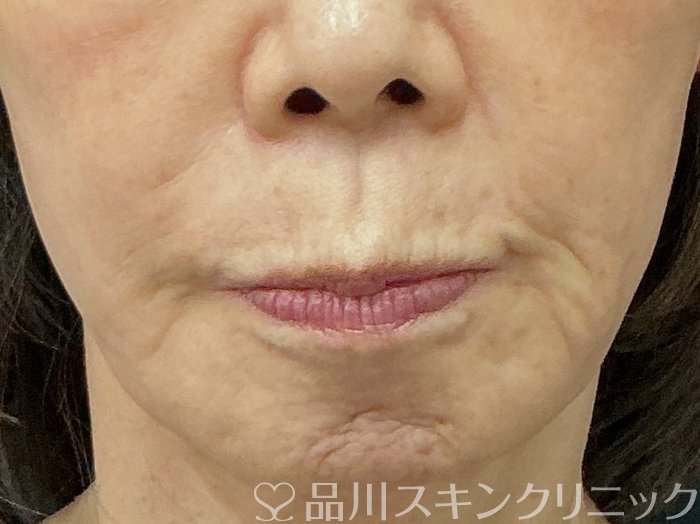 症例NO.74503のBEFORE写真