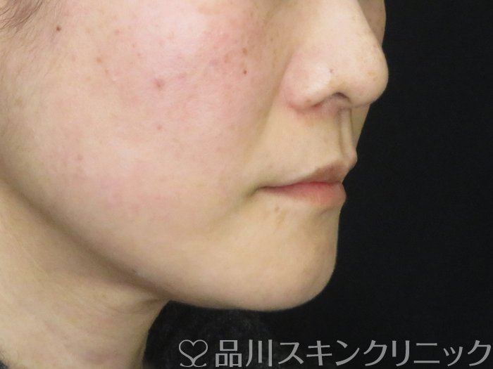 症例NO.63580のBEFORE写真