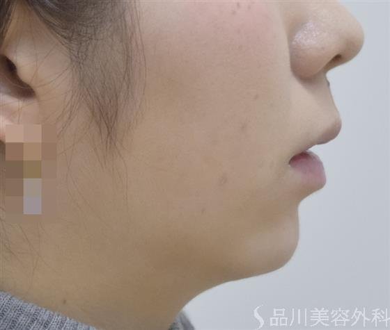 症例NO.46845のAFTER写真