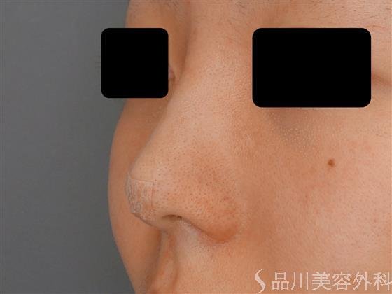 症例NO.60543のAFTER写真