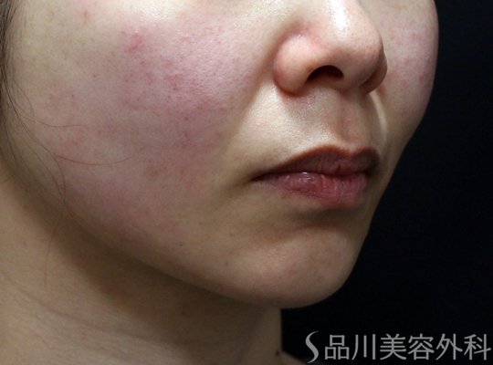 症例NO.73035のAFTER写真