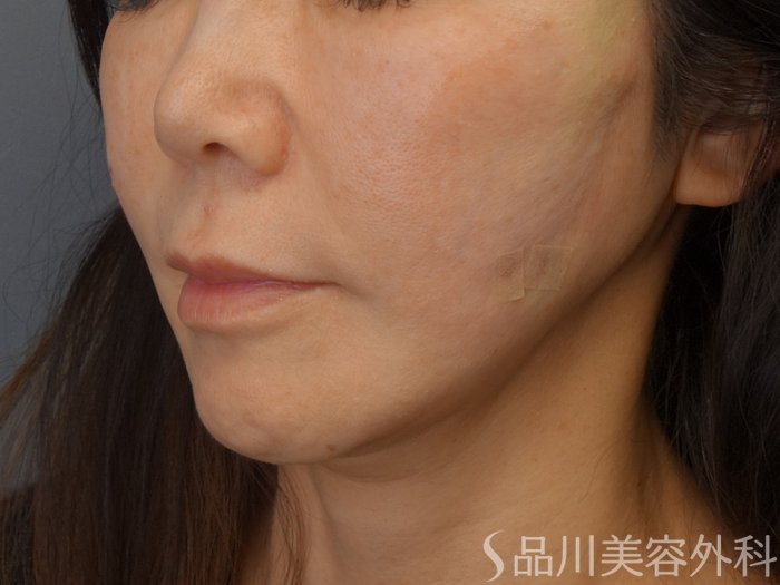 症例NO.74749のBEFORE写真