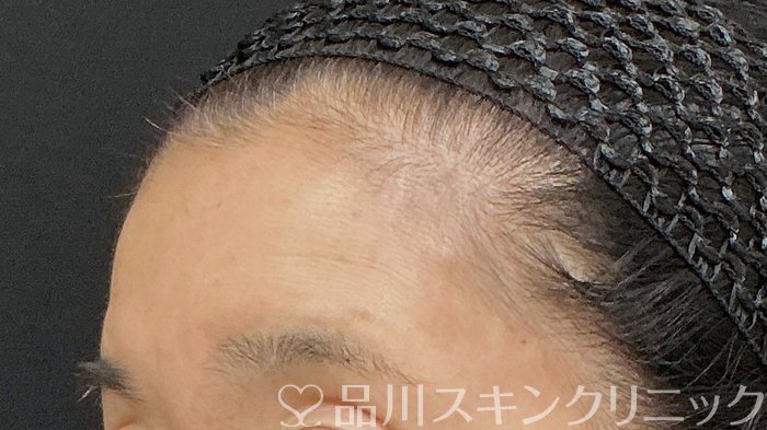 症例NO.74401のBEFORE写真
