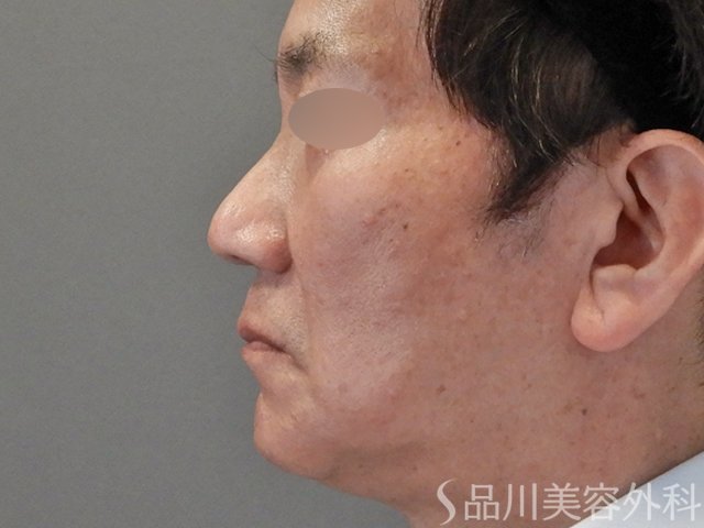 症例NO.74770のBEFORE写真